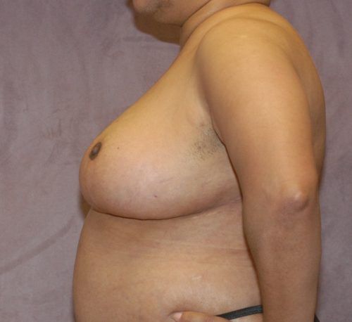 Breast Reduction And Lift Before & After