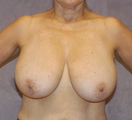 Breast Reduction And Lift Before & After