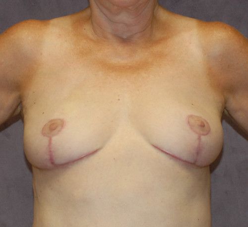 Breast Reduction And Lift Before & After