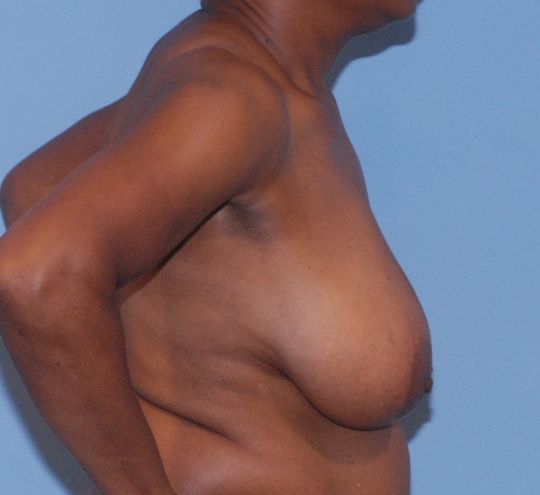 Breast Reduction And Lift Before & After