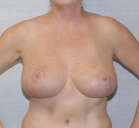 Breast Reduction And Lift Before & After