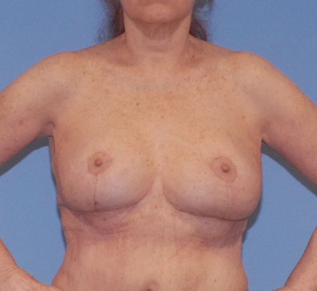 Breast Reduction And Lift Before & After