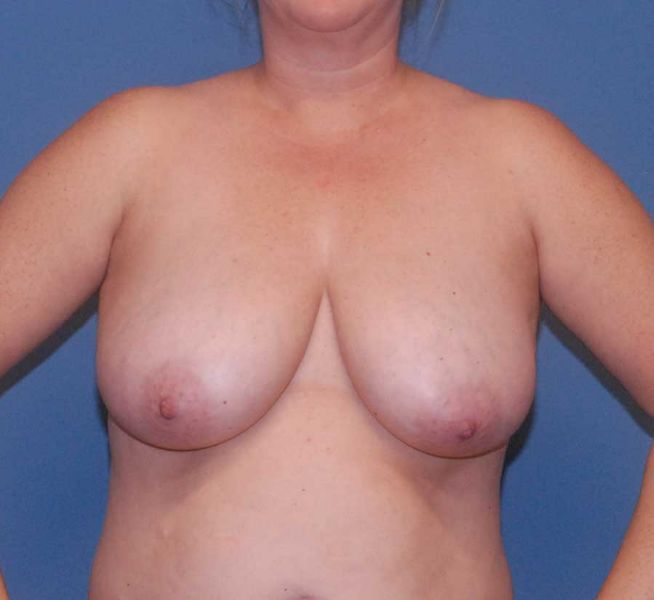 Breast Reduction And Lift Before & After