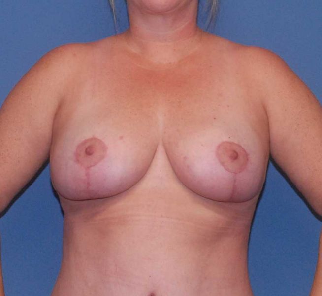 Breast Reduction And Lift Before & After