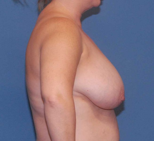 Breast Reduction And Lift Before & After