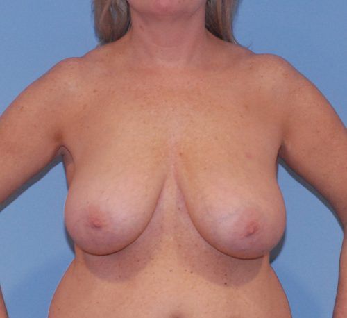 Breast Reduction And Lift Before & After