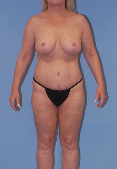 Breast Reduction And Lift Before & After