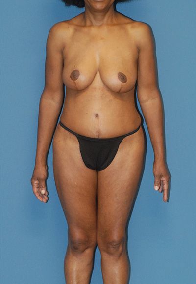 Breast Reduction And Lift Before & After
