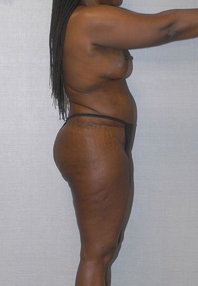 Breast Reduction And Lift Before & After