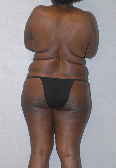 Breast Reduction And Lift Before & After