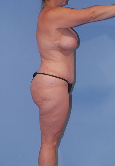 Breast Reduction And Lift Before & After