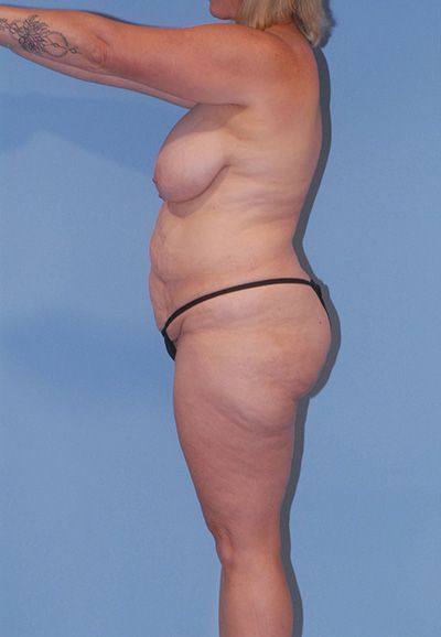 Breast Reduction And Lift Before & After