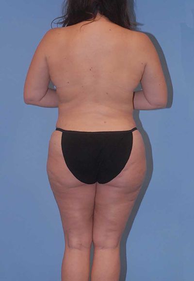 Breast Reduction And Lift Before & After