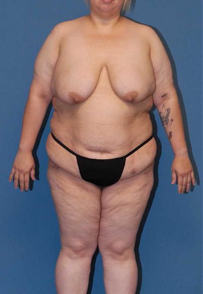 Breast Reduction And Lift Before & After