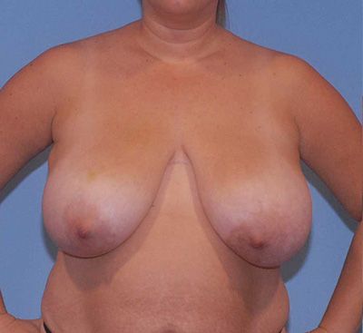 Breast Reduction And Lift Before & After
