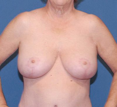Breast Reduction And Lift Before & After
