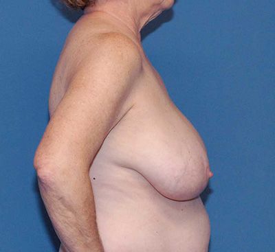 Breast Reduction And Lift Before & After