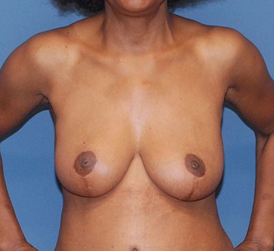 Breast Reduction And Lift Before & After