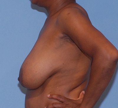 Breast Reduction And Lift Before & After