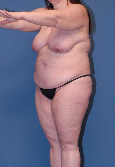 Breast Reduction And Lift Before & After