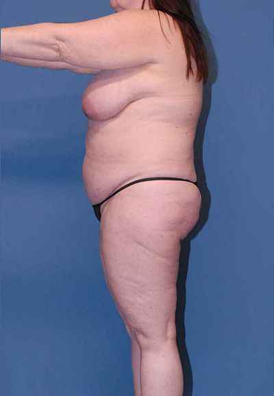 Breast Reduction And Lift Before & After