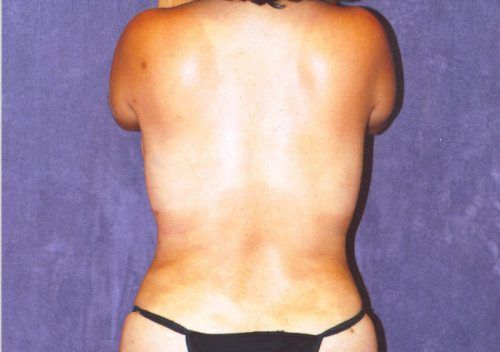 Abdominoplasty Before & After