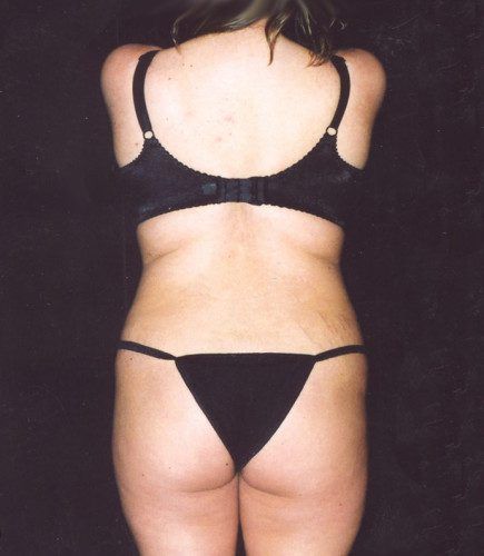 Abdominoplasty Before & After