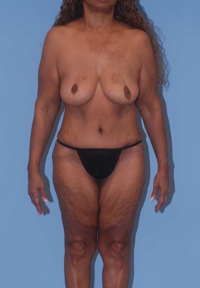 Abdominoplasty Before & After