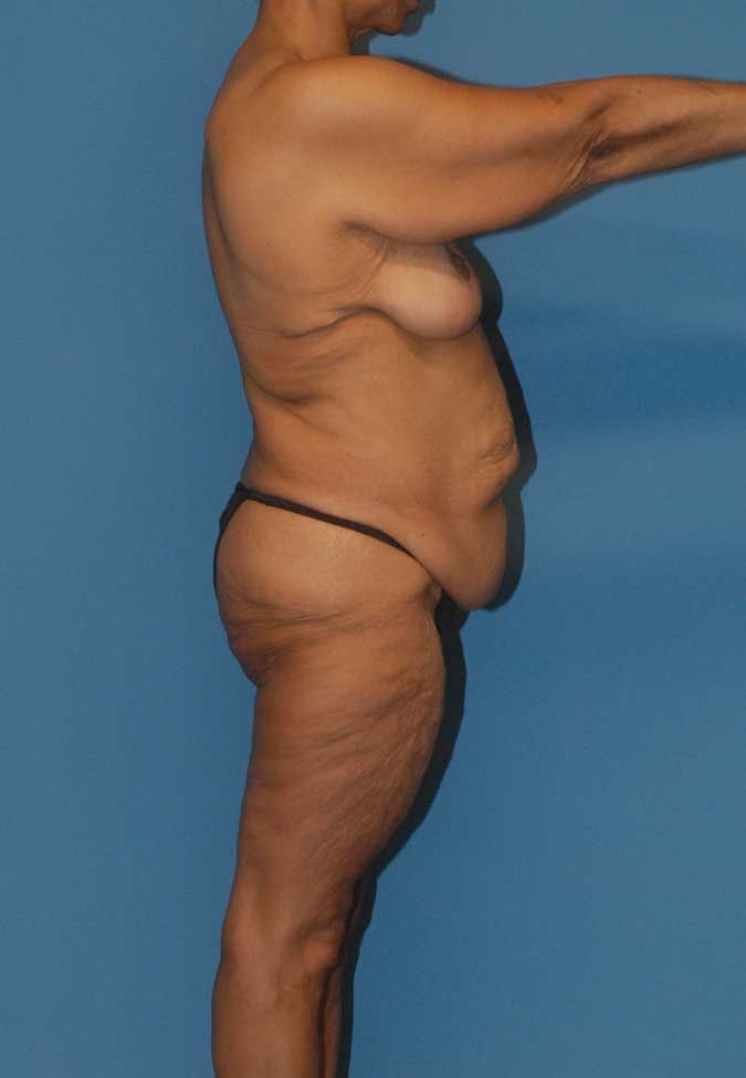 Abdominoplasty Before & After