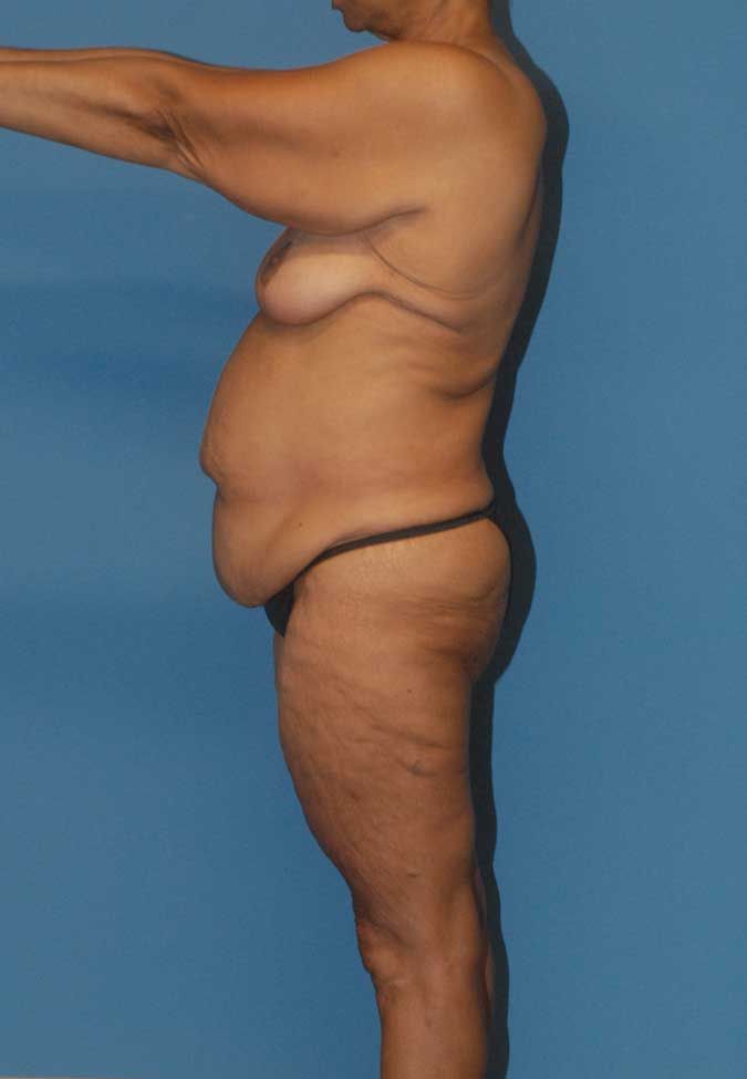 Abdominoplasty Before & After