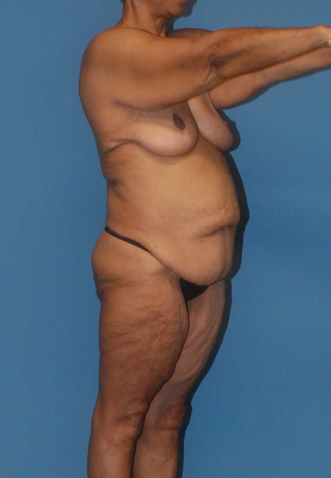 Abdominoplasty Before & After