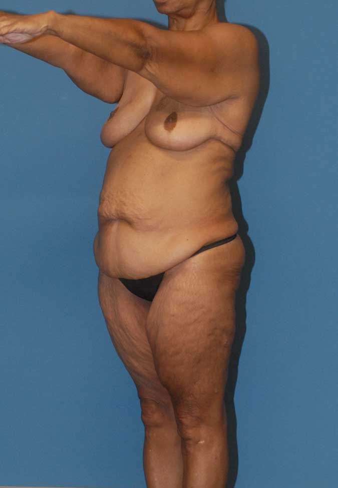 Abdominoplasty Before & After