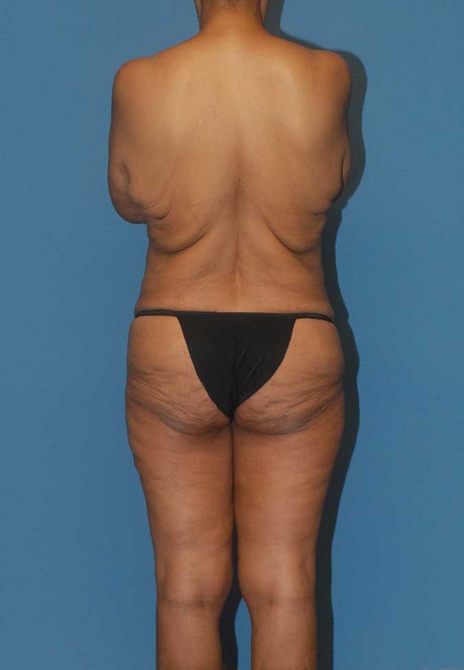 Abdominoplasty Before & After