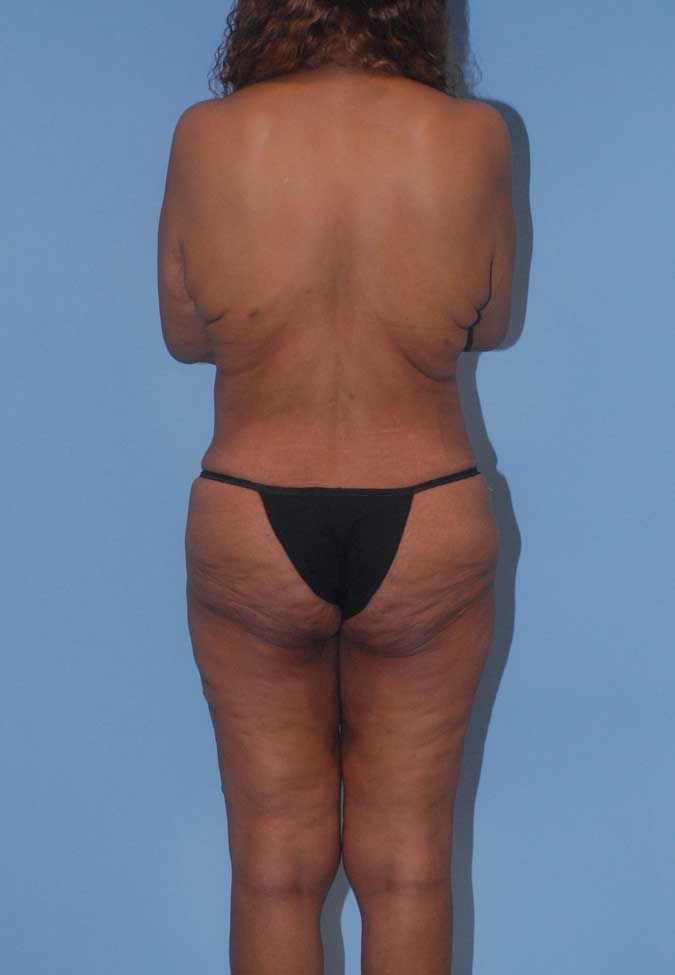 Abdominoplasty Before & After