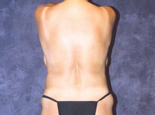 Abdominoplasty Before & After