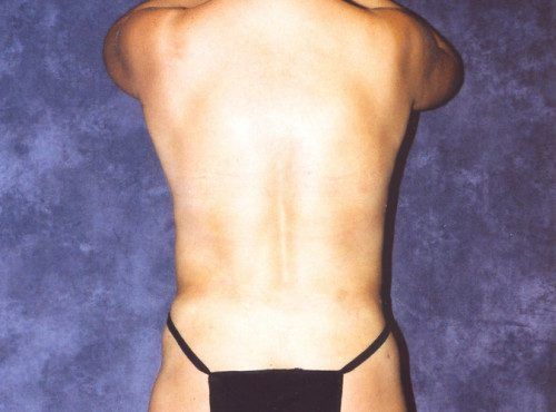 Abdominoplasty Before & After