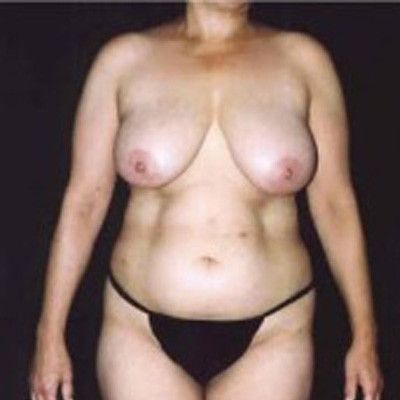 Abdominoplasty Before & After