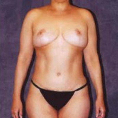 Abdominoplasty Before & After