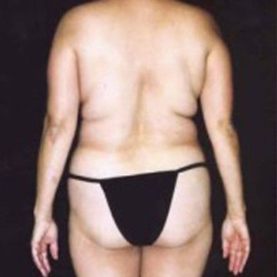 Abdominoplasty Before & After