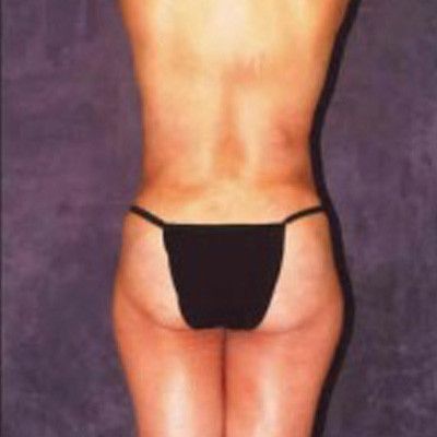 Abdominoplasty Before & After