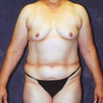 Abdominoplasty Before & After