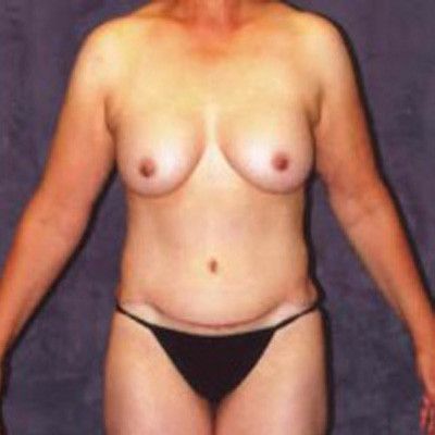 Abdominoplasty Before & After