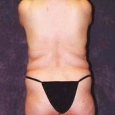 Abdominoplasty Before & After