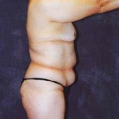 Abdominoplasty Before & After