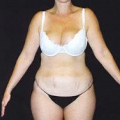 Abdominoplasty Before & After