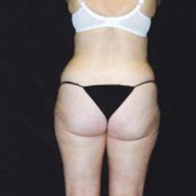 Abdominoplasty Before & After