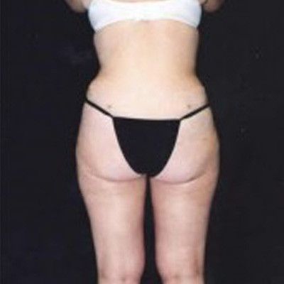 Abdominoplasty Before & After