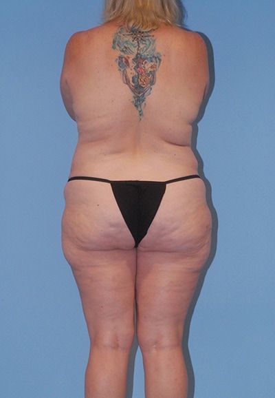 Abdominoplasty Before & After