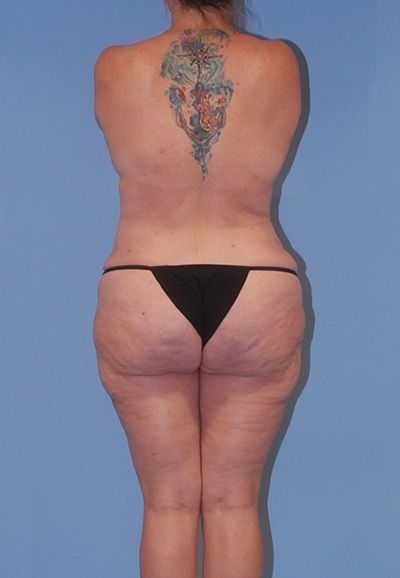 Abdominoplasty Before & After