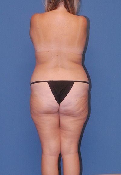 Abdominoplasty Before & After
